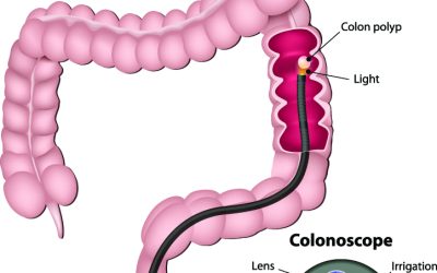 Understanding Insurance Coverage for a Colonoscopy in Miami, FL, Patients Should Know