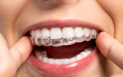 Clear Braces in Onalaska WI Provide a Comfortable Alternative to Traditional Metal Braces